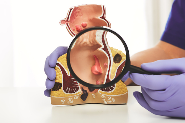                                               علاج الناسور الشرجي
                                              