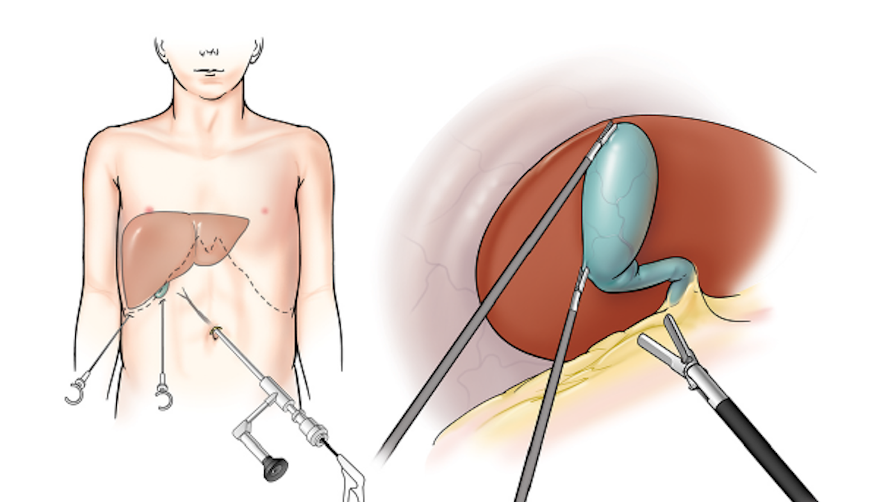                                               إزالة المرارة بالمنظار
                                              